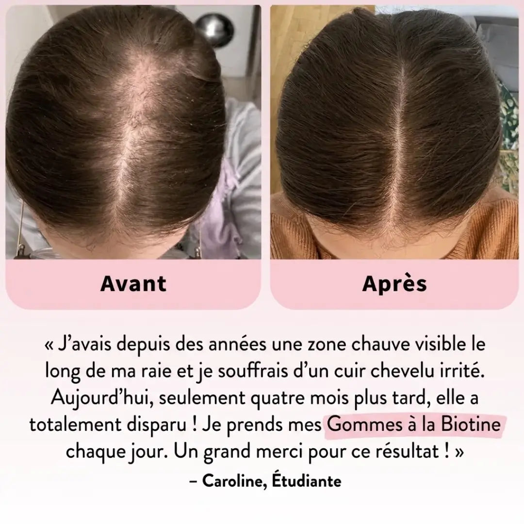 Sorlyn – Biotin Gummies for Hair Growth: Less hair loss, more confidence