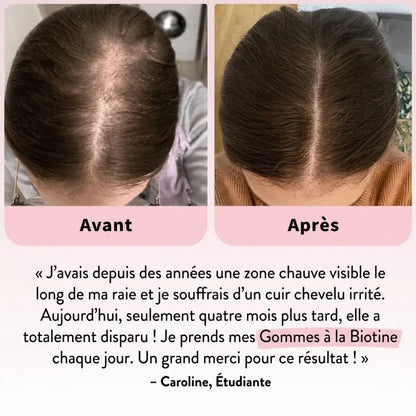 Sorlyn – Biotin Gummies for Hair Growth: Less hair loss, more confidence